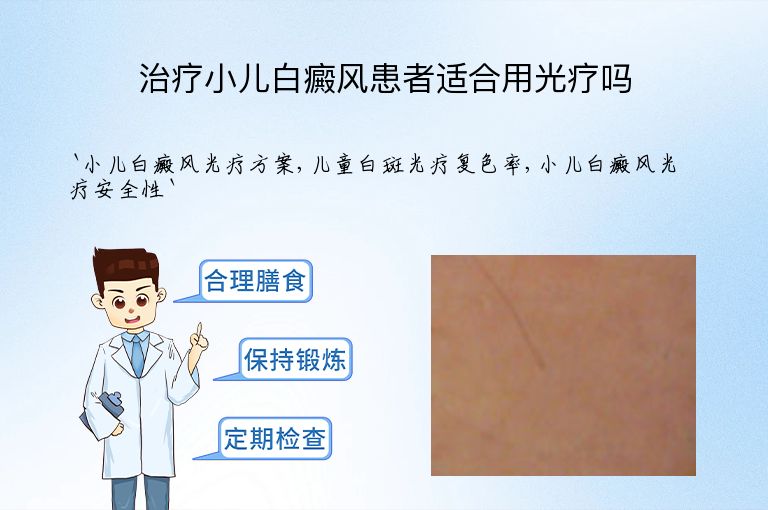 治疗小儿白癜风患者适合用光疗吗