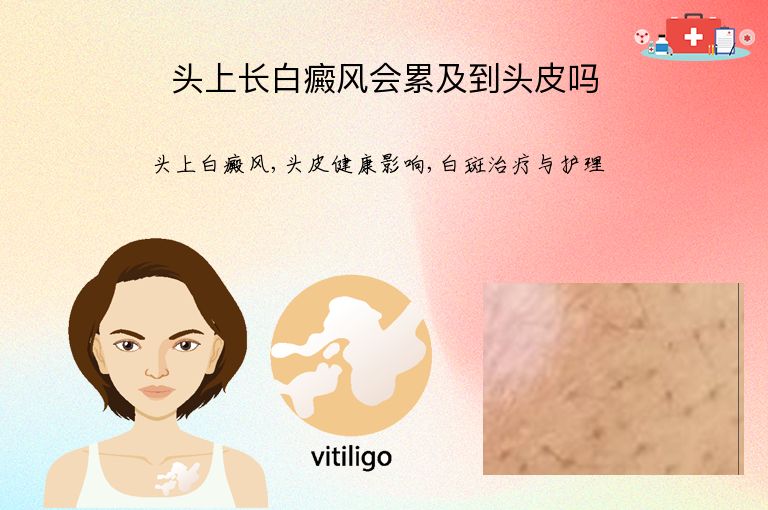 头上长白癜风会累及到头皮吗”