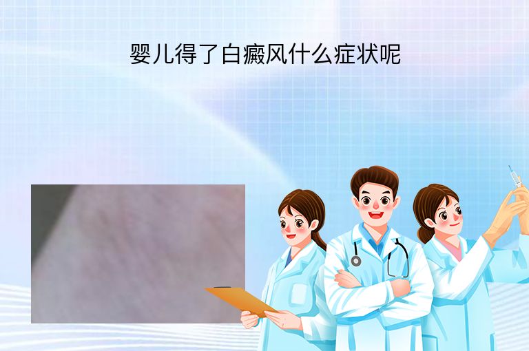 婴儿得了白癜风什么症状呢