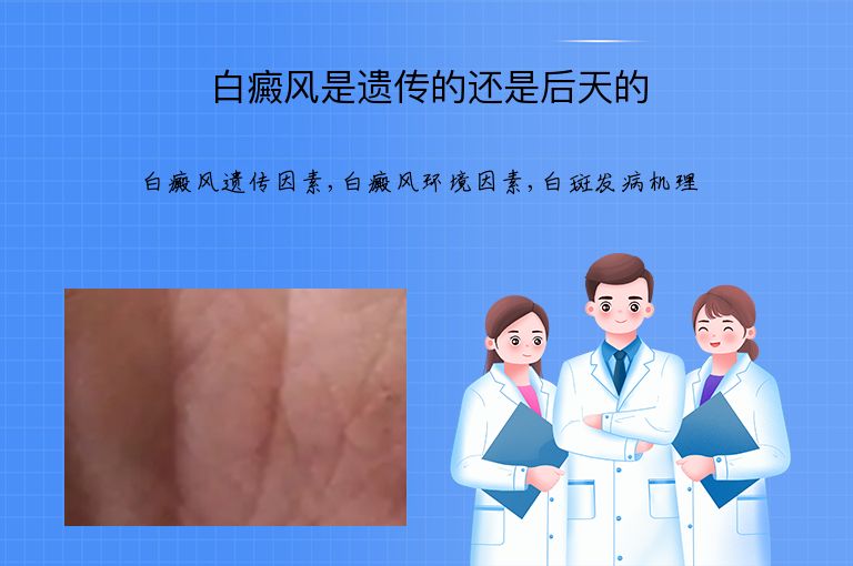 白癜风是遗传的还是后天的”