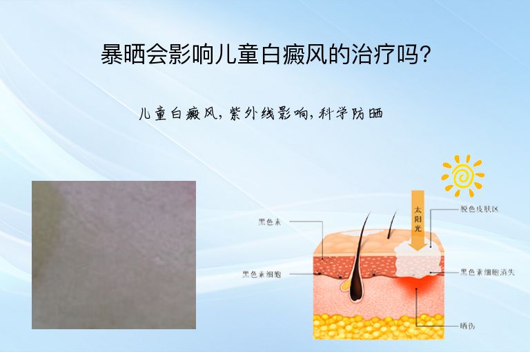暴晒会影响儿童白癜风的治疗吗?”