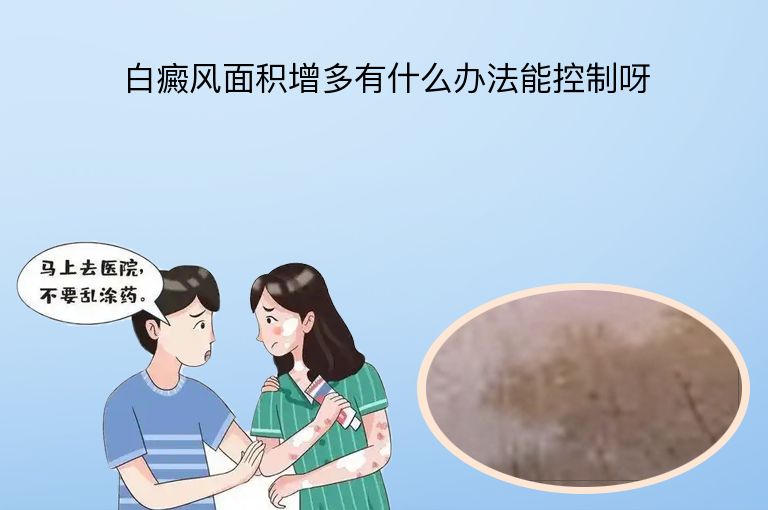 白癜风面积增多有什么办法能控制呀”
