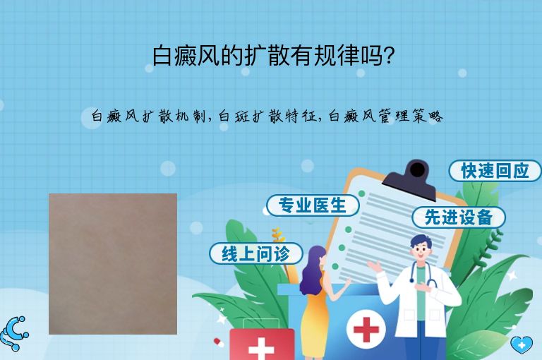 白癜风的扩散有规律吗？”