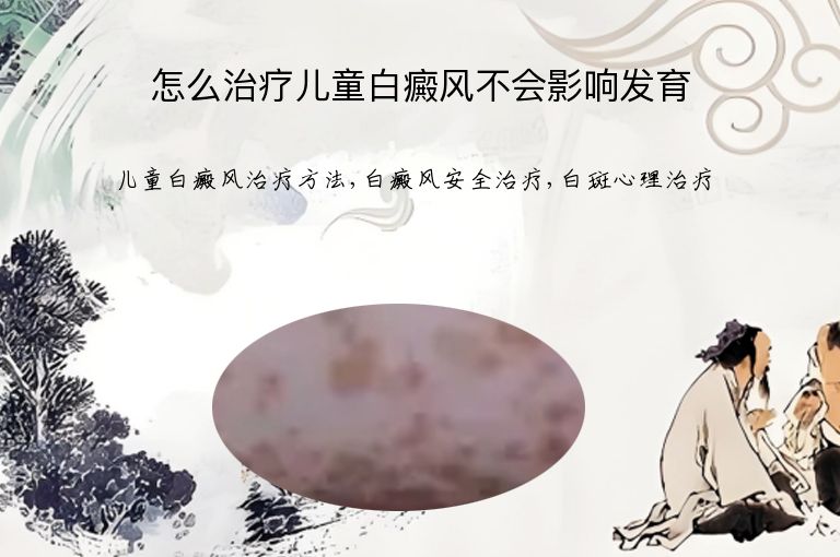 怎么治疗儿童白癜风不会影响发育”
