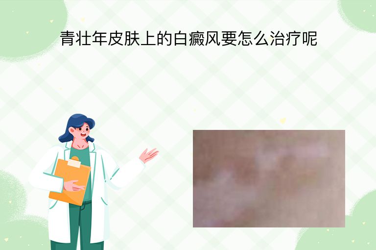 青壮年皮肤上的白癜风要怎么治疗呢”