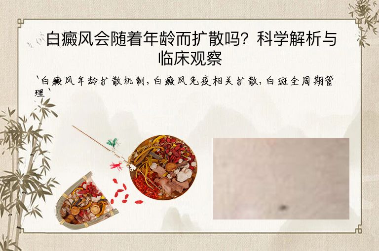 白癜风会随着年龄而扩散吗？科学解析与临床观察”