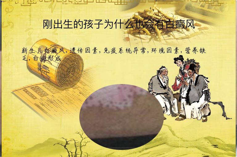 刚出生的孩子为什么也会有白癜风”