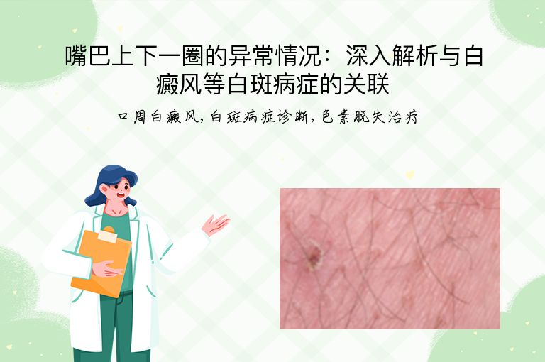 嘴巴上下一圈的异常情况：深入解析与白癜风等白斑病症的关联”