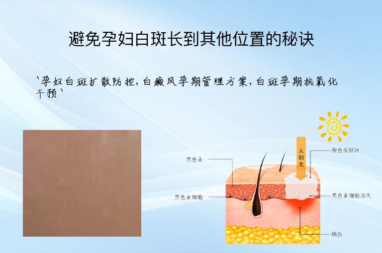 避免孕妇白斑长到其他位置的秘诀
