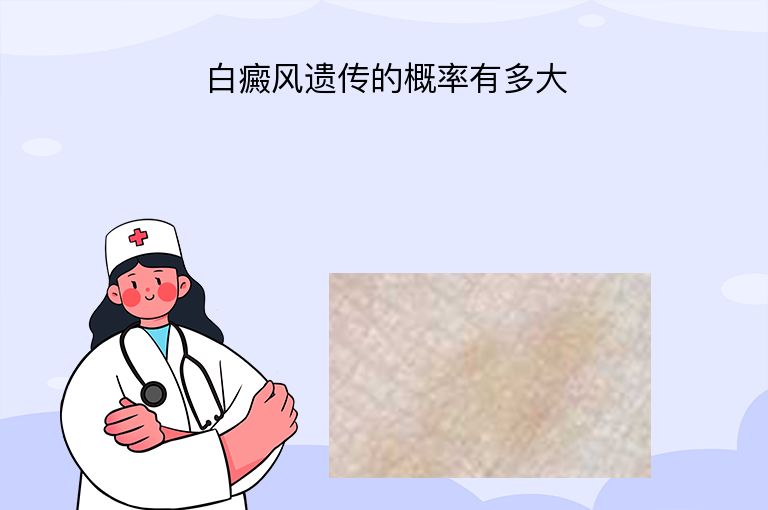 白癜风遗传的概率有多大”
