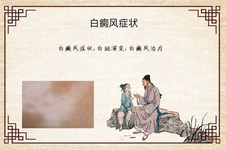 白癜风症状”