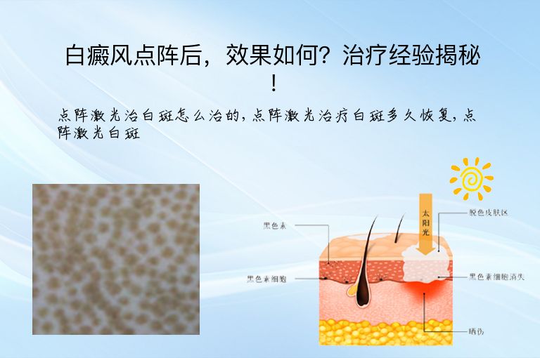 白癜风点阵后,效果如何?治疗经验揭秘!”