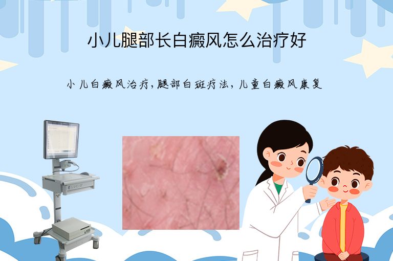 小儿腿部长白癜风怎么治疗好”