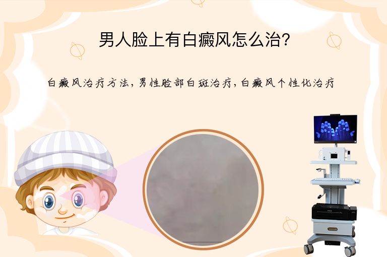 男人脸上有白癜风怎么治?”