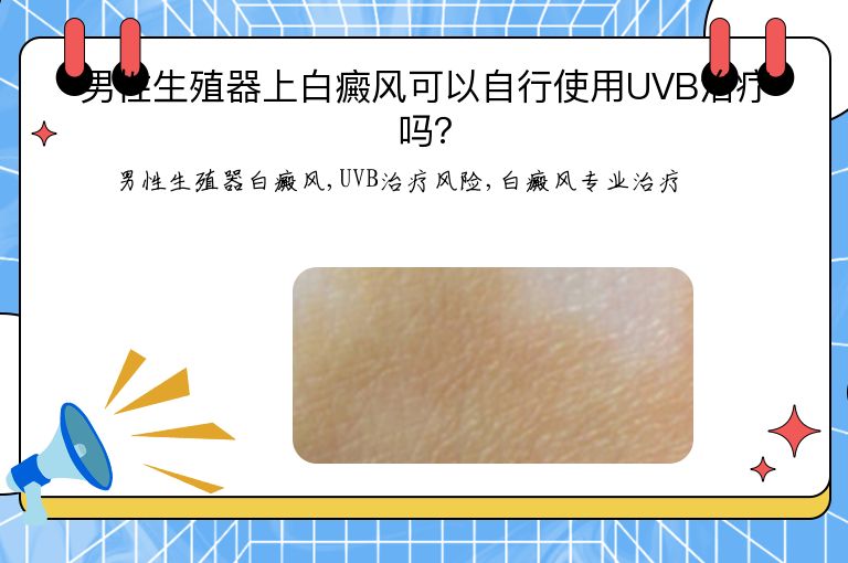 男性生殖器上白癜风可以自行使用UVB治疗吗?”