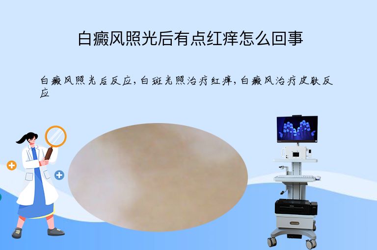 白癜风照光后有点红痒怎么回事”