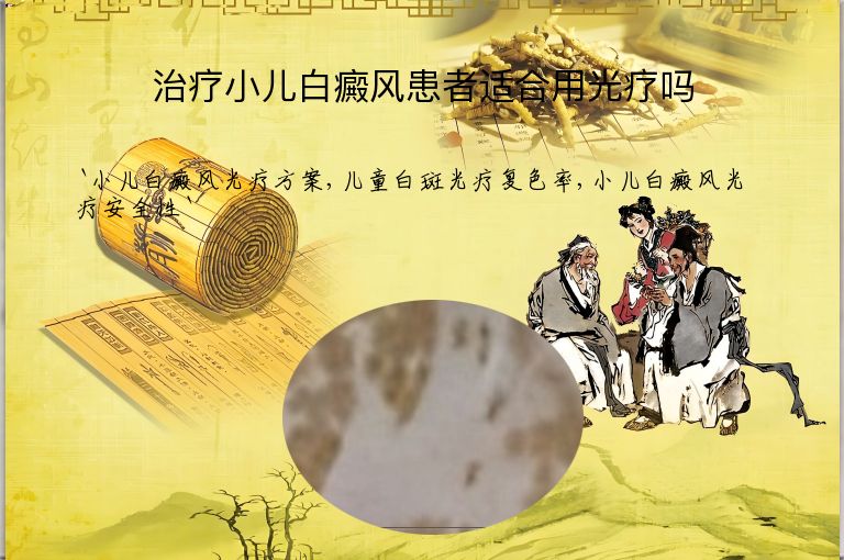 治疗小儿白癜风患者适合用光疗吗