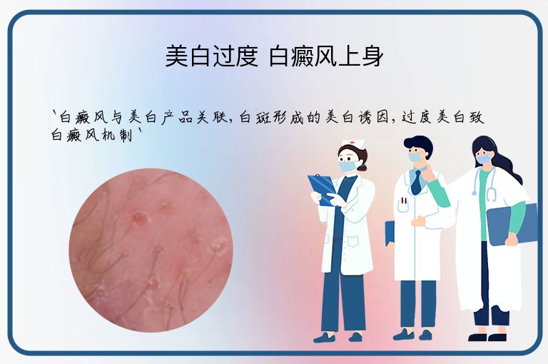 美白过度 白癜风上身”