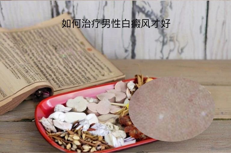 如何治疗男性白癜风才好”