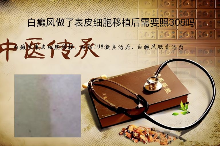 白癜风做了表皮细胞移植后需要照308吗”