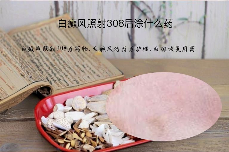 白癜风照射308后涂什么药”