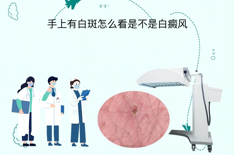 手上有白斑怎么看是不是白癜风