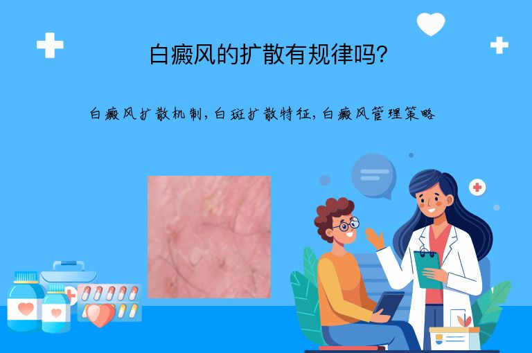 白癜风的扩散有规律吗?”