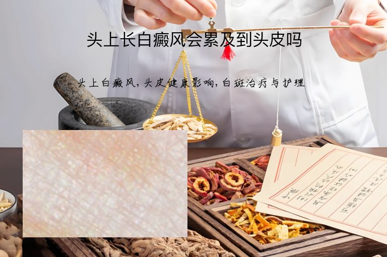 头上长白癜风会累及到头皮吗”