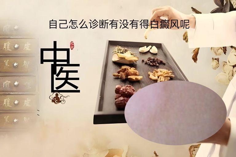 自己怎么诊断有没有得白癜风呢”