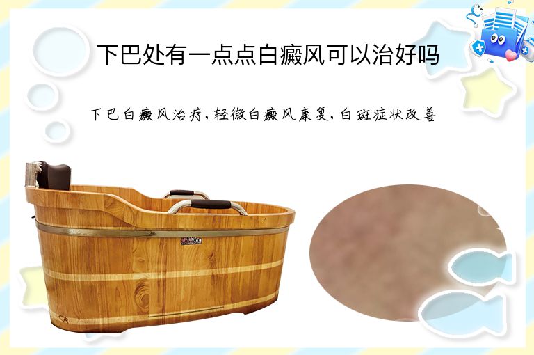 下巴处有一点点白癜风可以治好吗”
