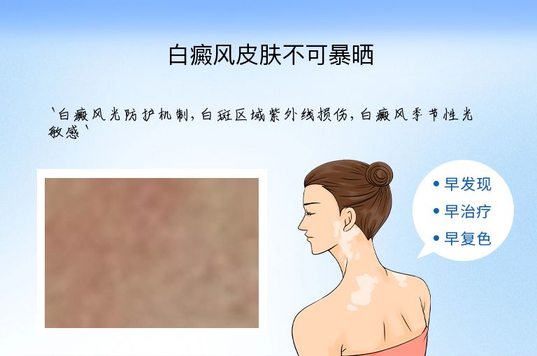 白癜风皮肤不可暴晒