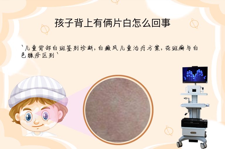 孩子背上有俩片白怎么回事