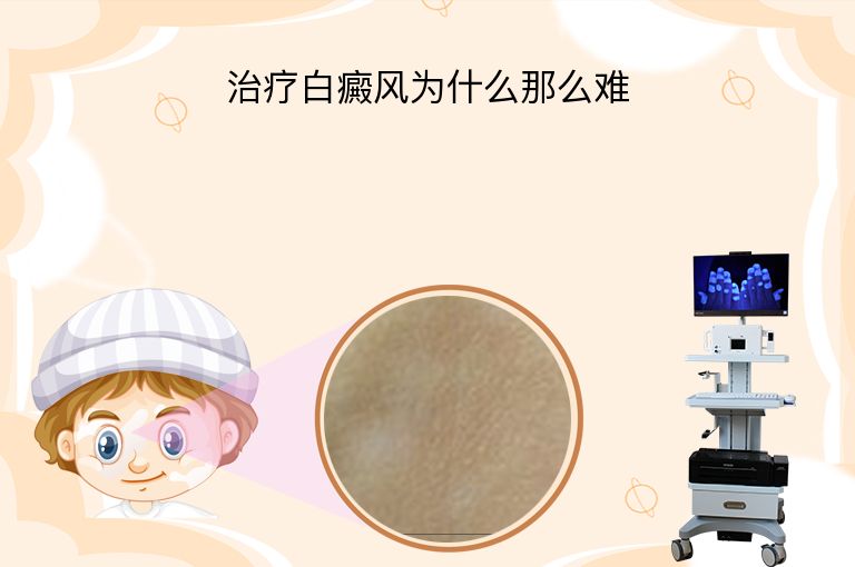 治疗白癜风为什么那么难”