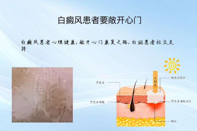 白癜风患者要敞开心门”