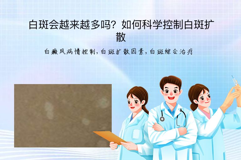 白斑会越来越多吗？如何科学控制白斑扩散”