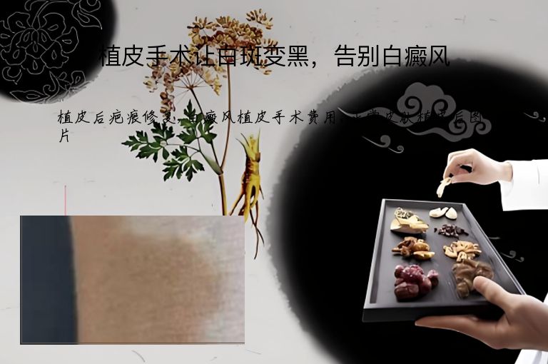 植皮手术让白斑变黑,告别白癜风”