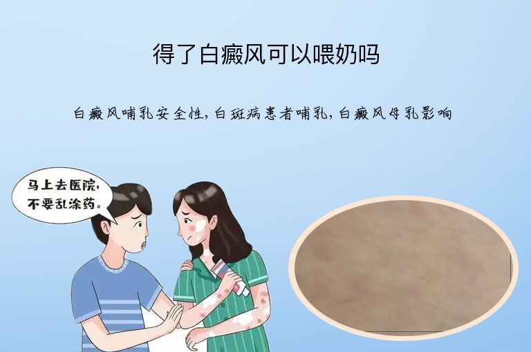 得了白癜风可以喂奶吗”
