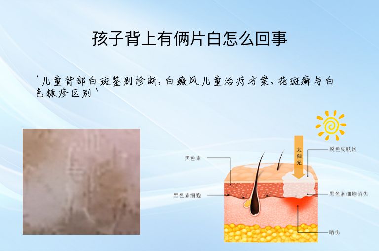 孩子背上有俩片白怎么回事