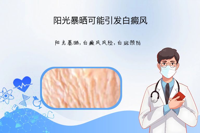 阳光暴晒可能引发白癜风”