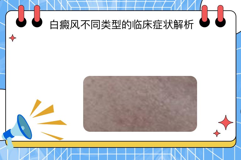 白癜风不同类型的临床症状解析
