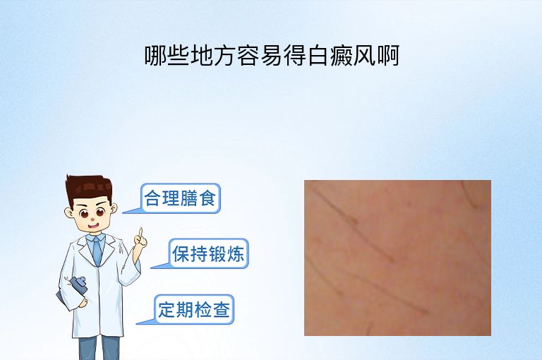 哪些地方容易得白癜风啊”