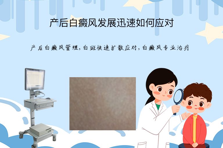 产后白癜风发展迅速如何应对”