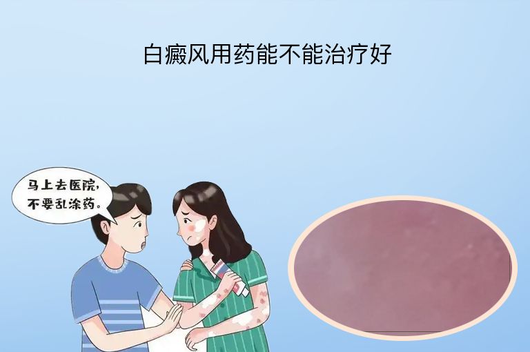 白癜风用药能不能治疗好”