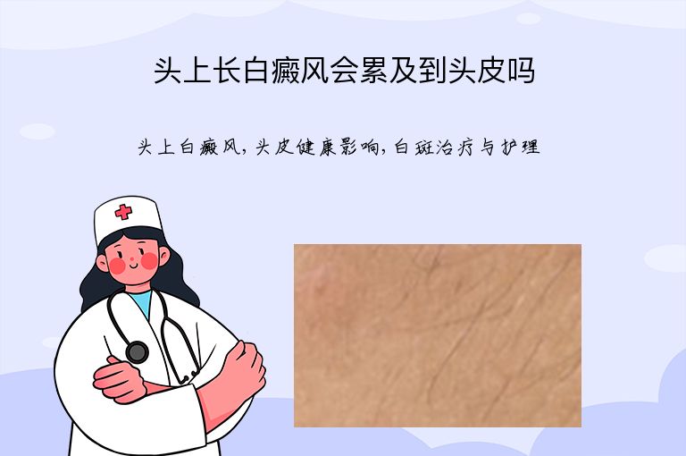 头上长白癜风会累及到头皮吗”
