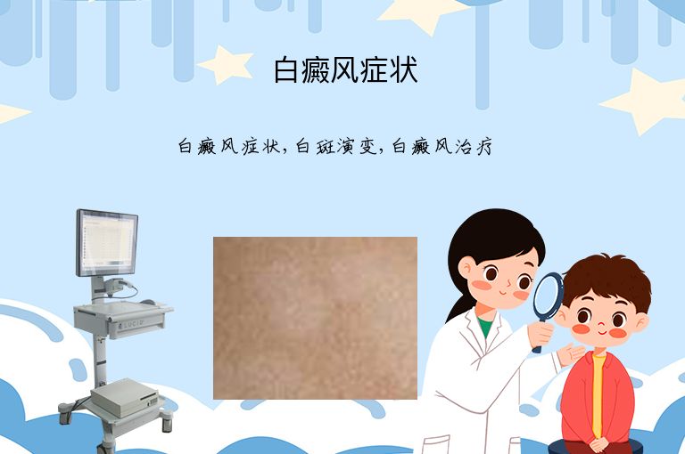 白癜风症状”