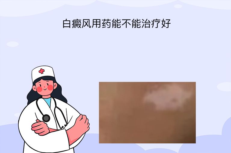 白癜风用药能不能治疗好”