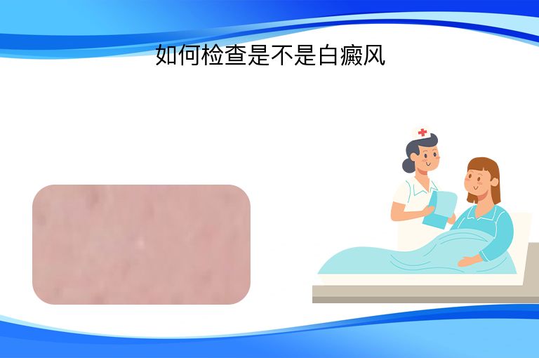 如何检查是不是白癜风