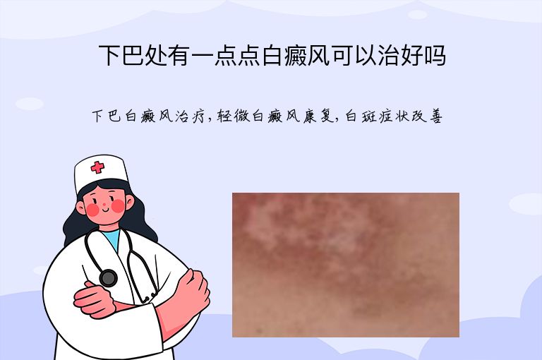 下巴处有一点点白癜风可以治好吗”