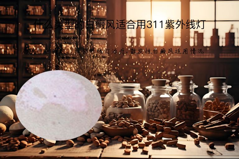 什么类型的白癜风适合用311紫外线灯”