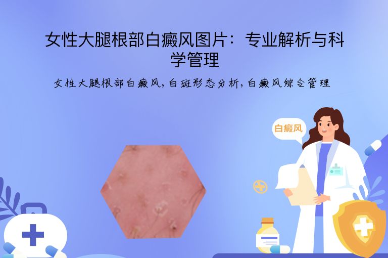 女性大腿根部白癜风图片：专业解析与科学管理”